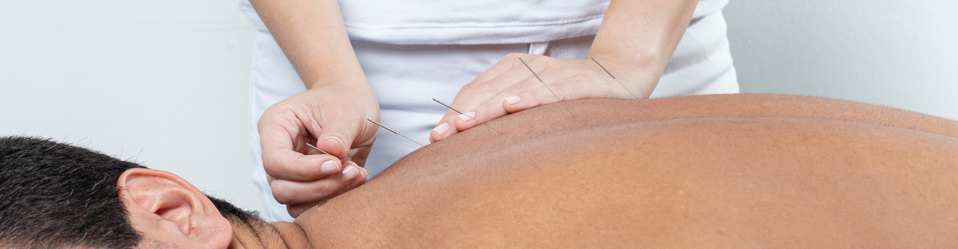 Acupuncture