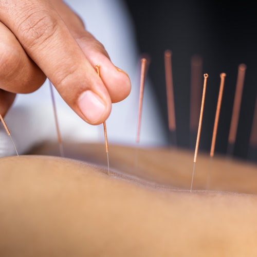 acupuncture-Montrose-Physiotherapy-and-Massage-Abbotsford-BC
