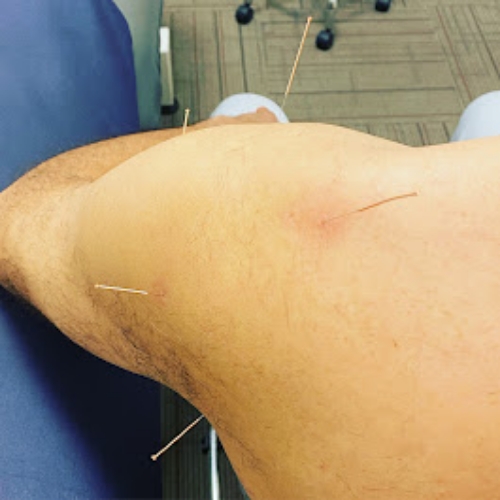 acupuncture-Montrose-Physiotherapy-and-Massage-Abbotsford-BC-clinic-pic